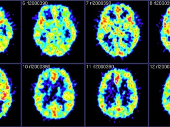 Eight images of brain scans with varying levels of blue, red, green, and yellow.